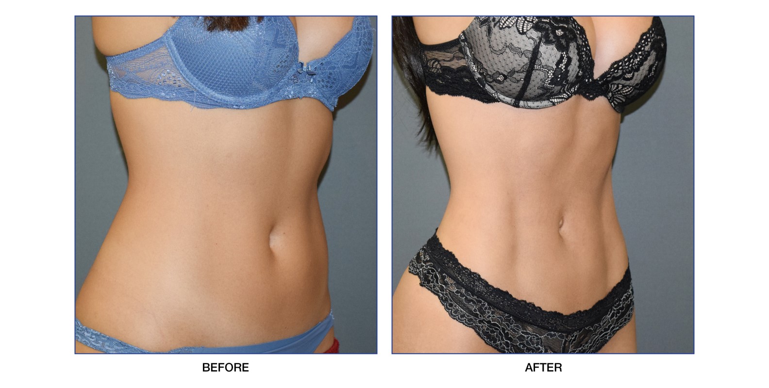 Vaserlipo Surgical Procedure Lombardo Cosmetic 