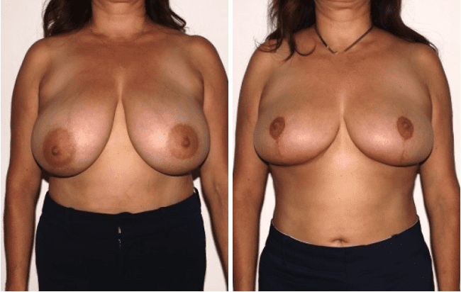 Breast Reduction Surgery Before & After Palm Desert CA