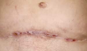 Abdominoplasty Palm Desert CA